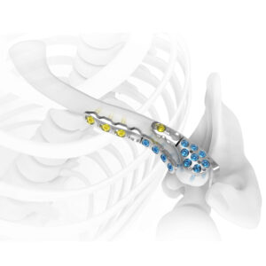 NEWCLA Clavicle Locking plate