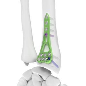 NEWCOLLE V3 Distal Radio y Distal Ulna Locking Plate