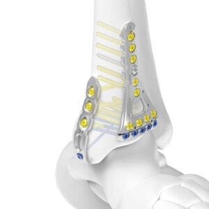 NEWMALLE Ankle Locking Plate