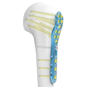 PHLP Proximal Humerus Locking plate